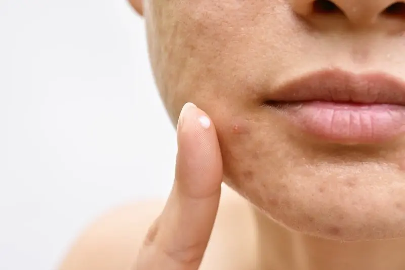 femme avec des problèmes de peau, Imperfections cutanées