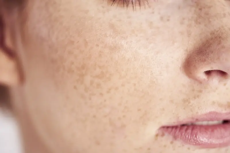 femme avec des tâche de rousseur