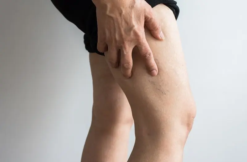 chirugie pour enlever les varicosités des jambes